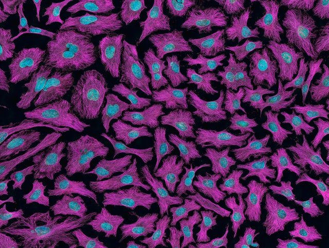 Cancer Staging